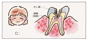 むし歯はどうしてできるのでしょう？