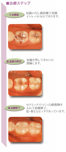 治療のステップ